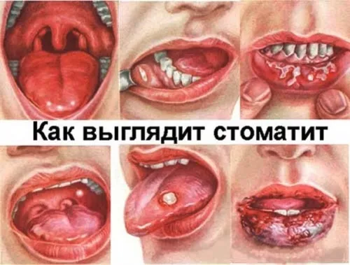 дитина мову виразка фото білий лікувати ранка причина червоний виразка