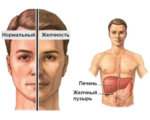 Жовтяниця: симптоми як лікуватися від жовтяниці