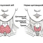 як лікувати токсичний зоб
