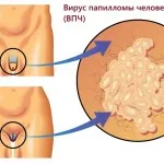 як лікувати папіломи і бородавки