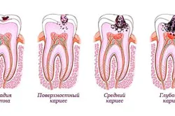 ніж лікувати пляшковий карієс