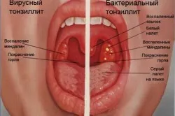 здорове горло