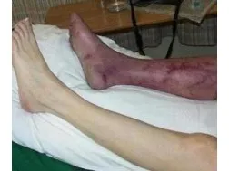 гангрена ноги фото початкова стадія відгуки загальна характеристика хвороби причини перші ознаки види як лікувати прогноз на життя відео