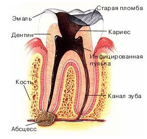 як лікувати флюс на щоці