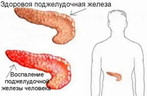 як лікувати печію і відрижку