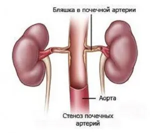 як лікувати судини нирок