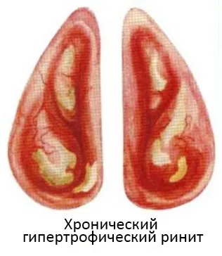 Гіпертрофічний риніт як лікувати гіпертрофічний риніт