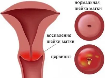 як лікувати хламідійний цервіцит
