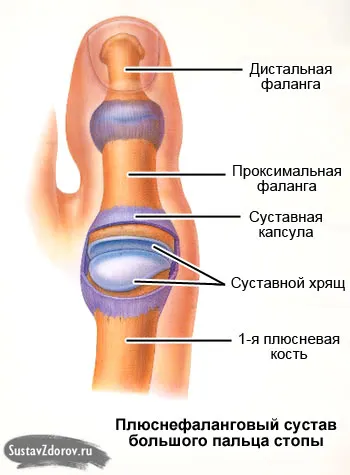 як лікувати деформуючий артроз стопи