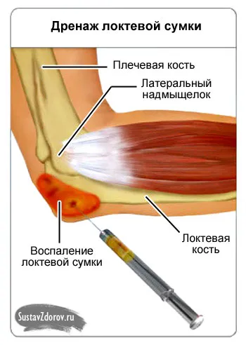 лікувати ліктьовий суглоб