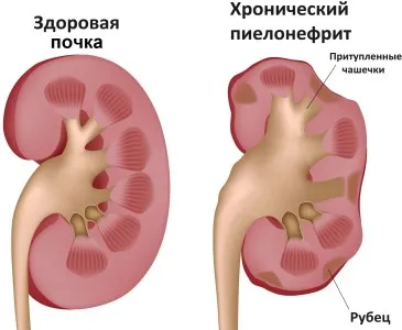 ніж лікувати нирки у чоловіків