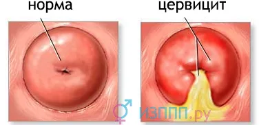як лікувати цервіцит шийки матки