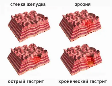 як лікувати ерозію шлунка в домашніх умовах