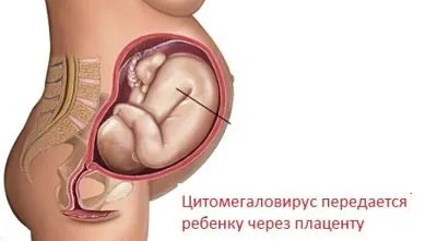 як лікувати цитомегаловірус у жінок