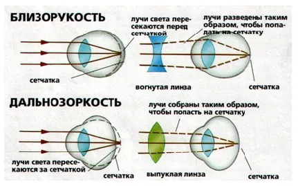 лікувати короткозорість без операції