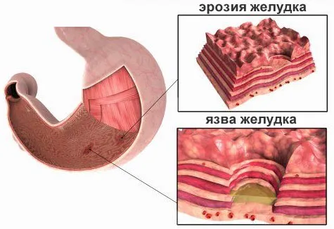 ерозія шлунка