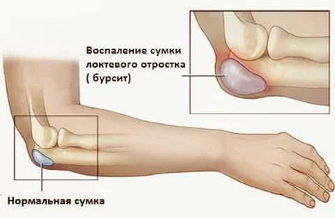 Бурсит: симптоми і причини, лікування і профілактика як лікувати вертельную бурсит