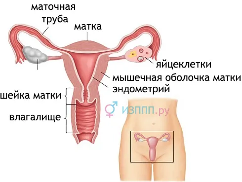 як лікувати цервіцит шийки матки