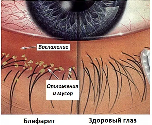 як лікувати блефарит в домашніх умовах