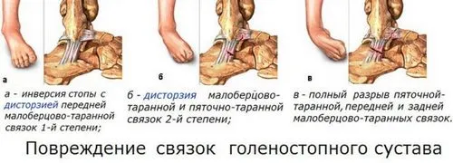 як лікувати гомілковостопні суглоби