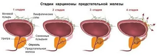 як лікувати рак простати 4 стадії