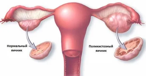 чи можна вилікувати гормональне безпліддя