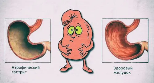 як вилікувати атрофічний гастрит народними засобами