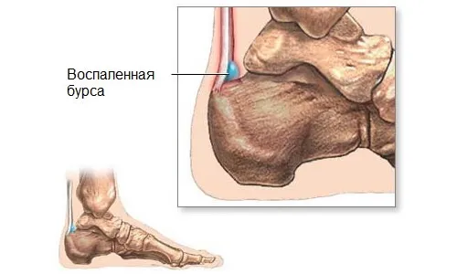 як лікувати бурсит п'яти