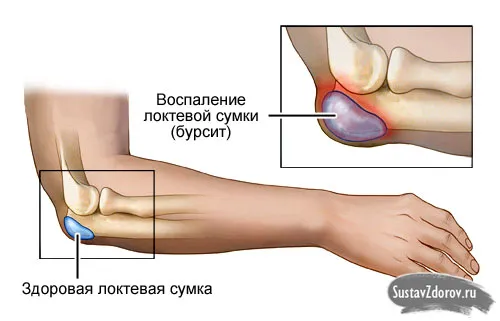 лікувати ліктьовий суглоб