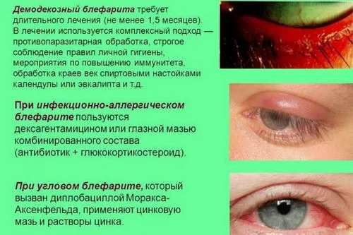 як лікувати блефарит в домашніх умовах
