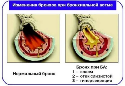 як лікувати астму без гормонів