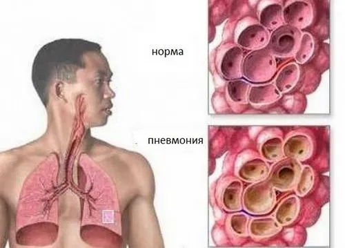 бактеріальна вірусна пневмонія тканини легені бактерії віруси гемофільна паличка пневмококи стрептококи причини симптоми лікування