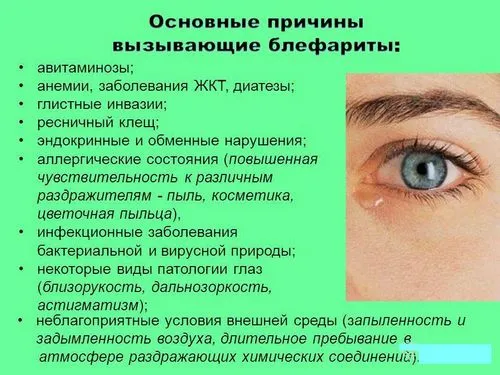 як лікувати блефарит в домашніх умовах