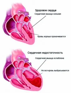 тахікардія лікувати вдома