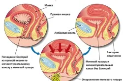 перший по циститу