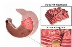 лікування гастриту