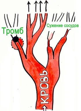 як лікувати варикоз тромбофлебіт