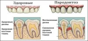 як лікувати ясна уколами