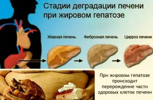 як лікувати гепатоз печінки