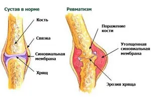 як лікувати летючий ревматизм
