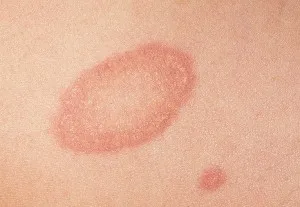 як лікувати псоріаз на шиї