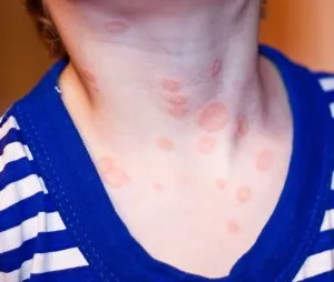 лишай шия людина фото псоріаз