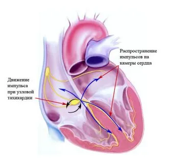 як лікувати наджелудочковую тахікардію