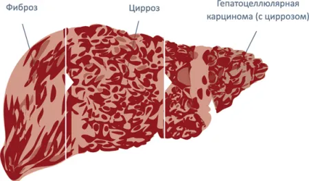 гепатит ц лікується чи ні