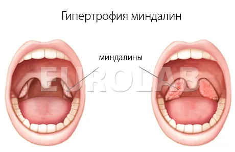 як лікувати гіпертрофовані мигдалини