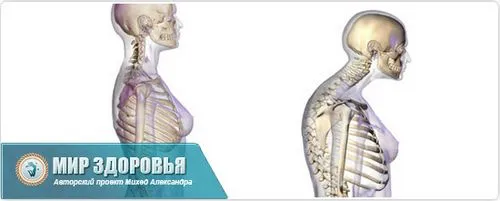 як лікувати остеопороз шиї