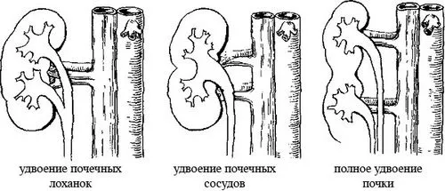 як лікувати подвоєння нирки