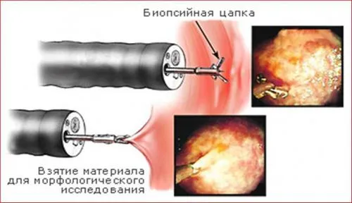 як лікують рак шлунка 1 стадії