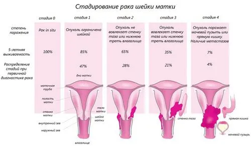як лікувати рак шийки матки 3 ступеня
