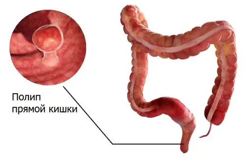 як лікувати геморой і поліпи